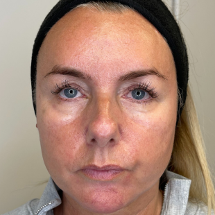 Front view of a ladies face before HydraFacial treatment