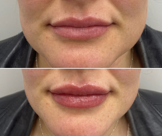 Close up of woman's lips before and after dermal filler enhancement