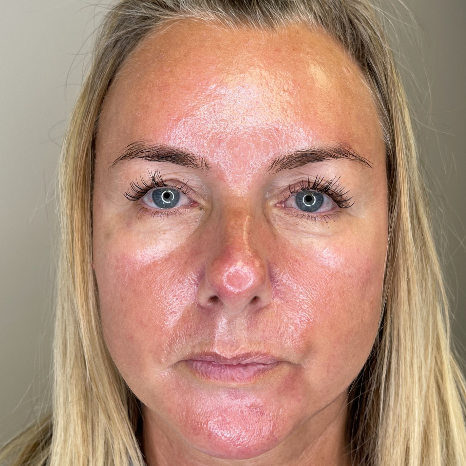 Front view of a ladies face after HydraFacial treatment