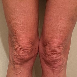 Close Up of a Woman’s Knees