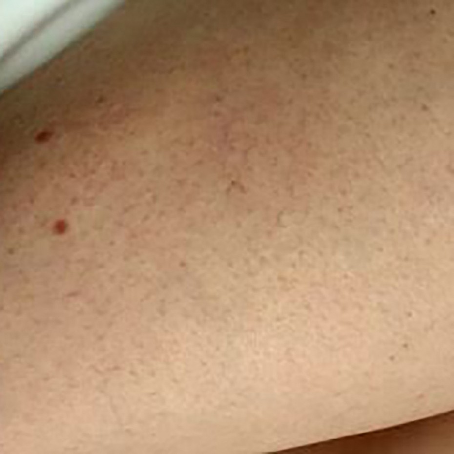 Legs after thread vein treatment