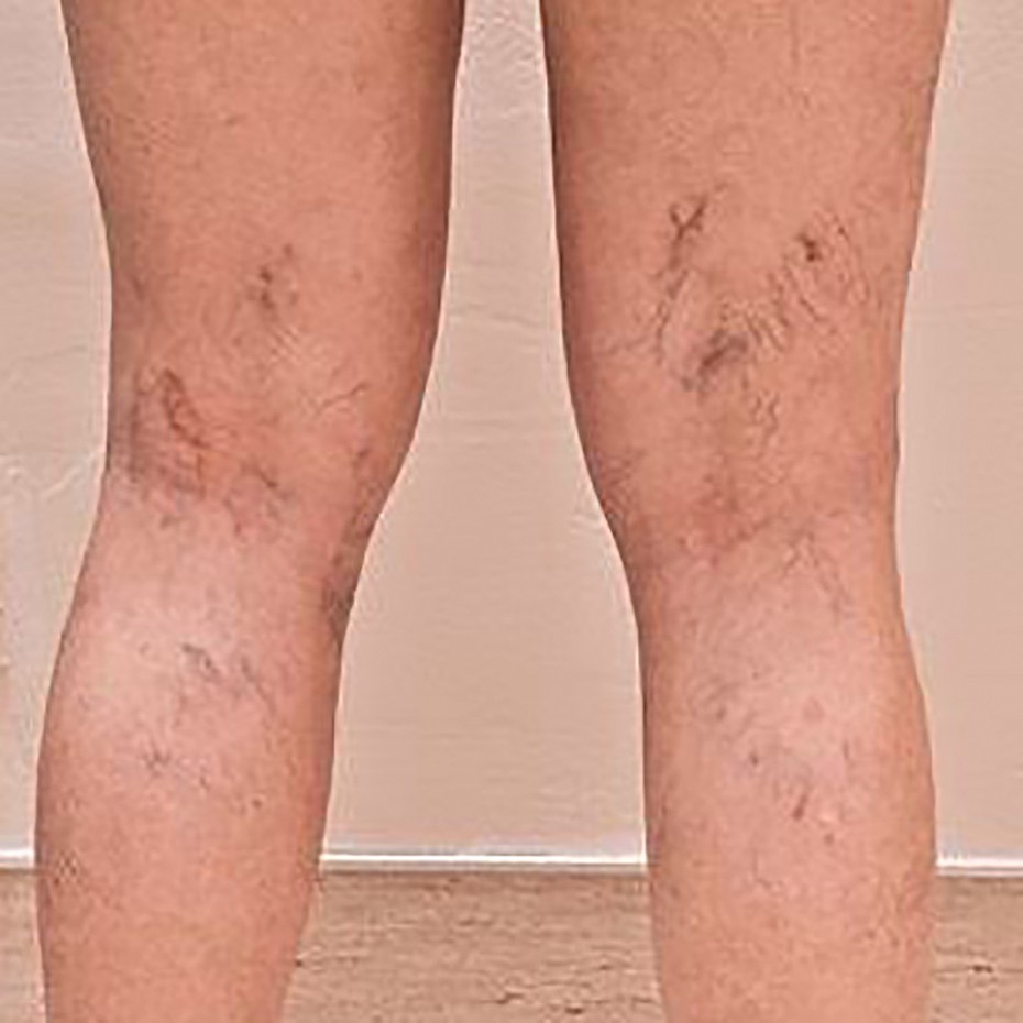 Legs before thread vein treatment