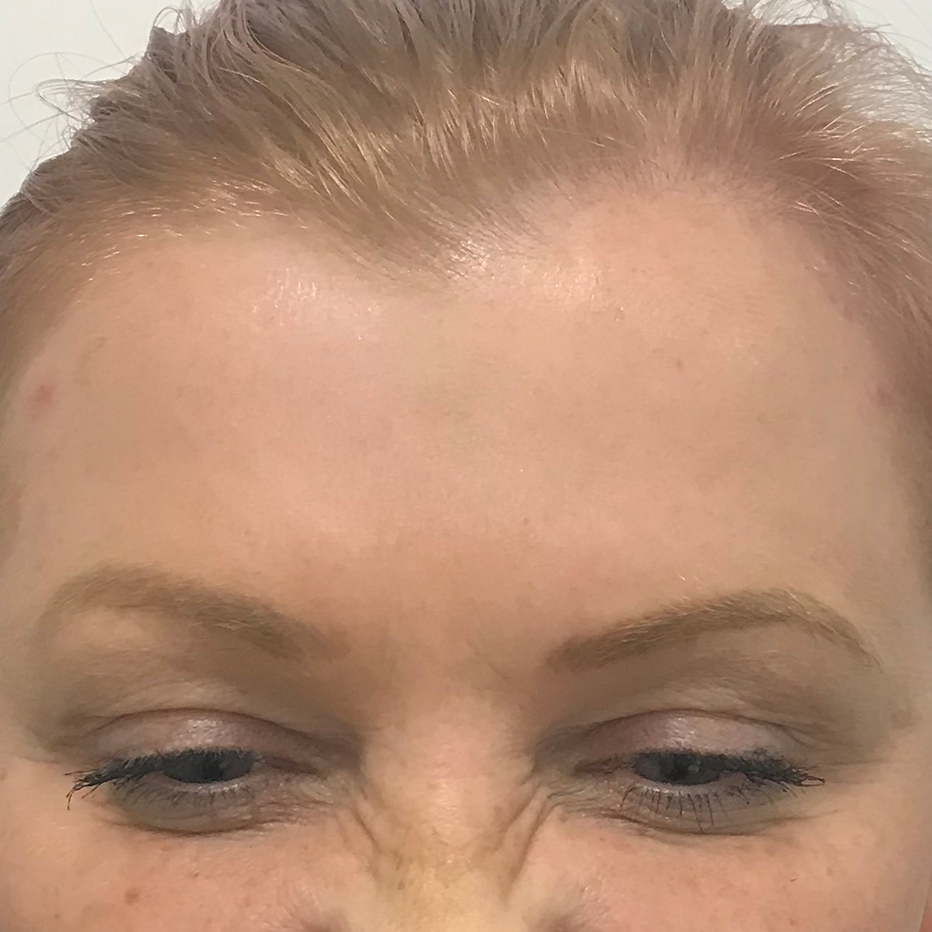 Woman's forehead