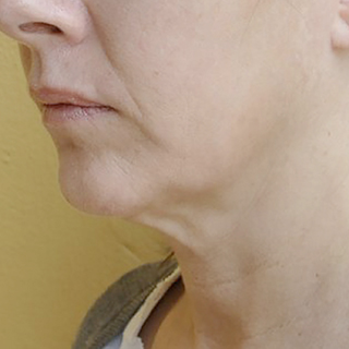 Side view of a Woman's Jaw and Chin