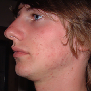 Side profile of a cheek with clear skin complextion