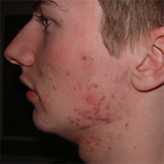 Side profile of a cheek with angry red acne