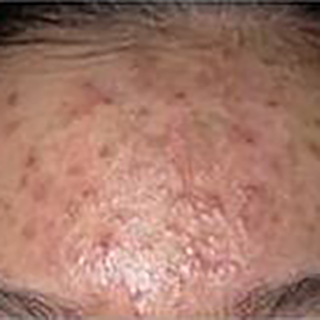 Forehead with blotchy, spotty skin