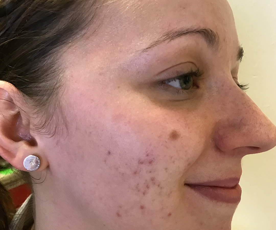 Close Up of woman's cheek with skin blemishes